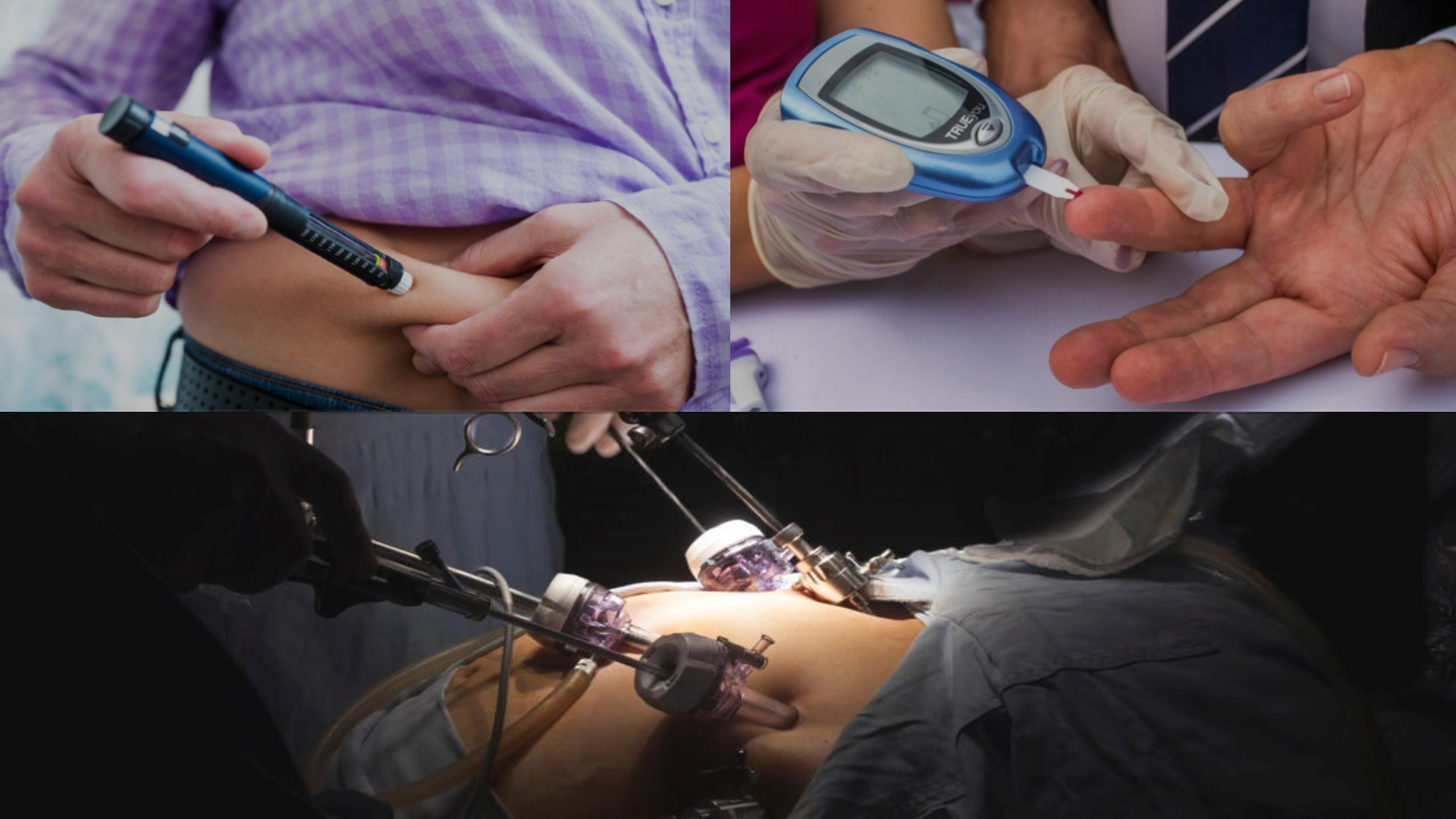 Bariatric Surgery
